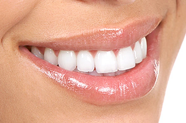 Veneers 2 veneers Dubai
