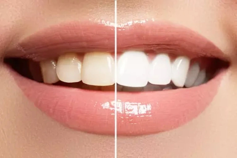 Teeth Whitening Dubai 4 Teeth whitening Dubai