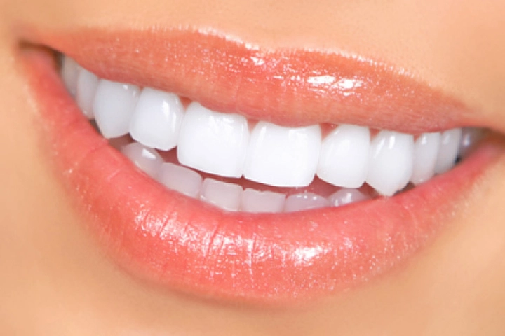 Veneers 3 veneers Dubai
