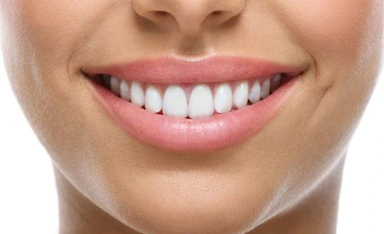 Veneers 4 veneers Dubai