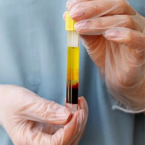 Platelet-Rich Plasma treatment 5 prp treatment Dubai