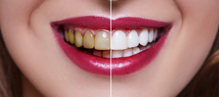 Veneers 5 veneers Dubai