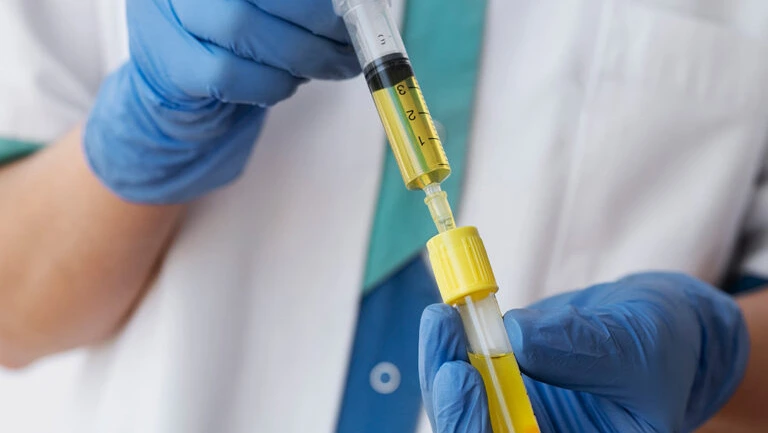 Platelet-Rich Plasma treatment 6 prp treatment Dubai