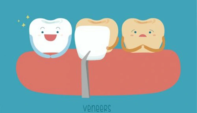 Veneers 6 veneers Dubai