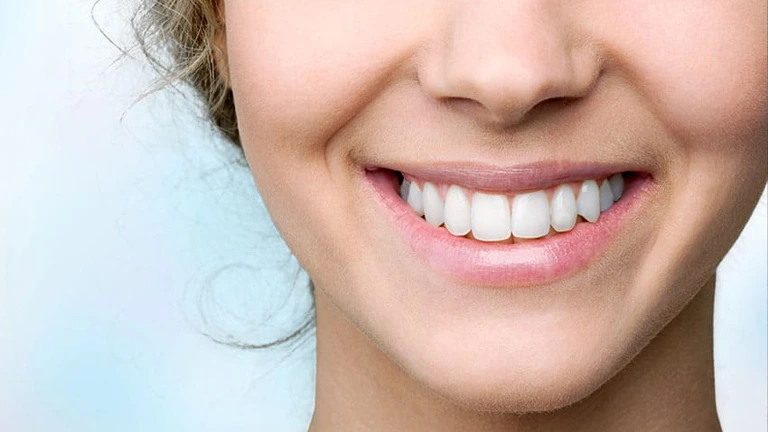 Veneers 8 veneers Dubai