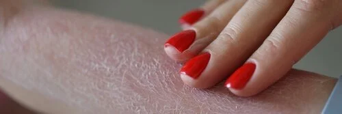 Dry skin in summer