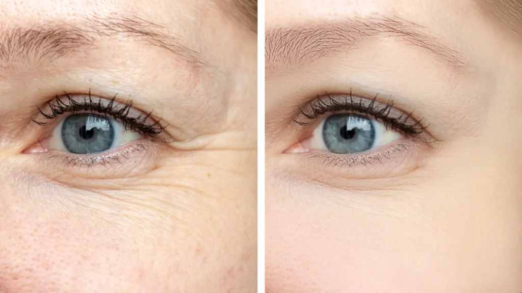 What are some natural ways to prevent wrinkles and fine lines