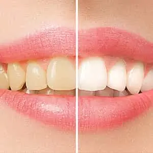 best-Hollywood-Smile-duba