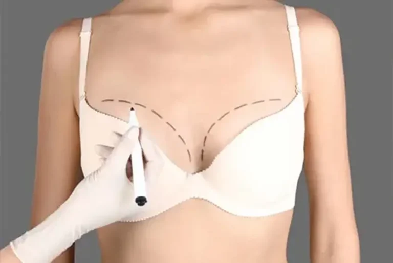 Nonsurgical Breast Lift