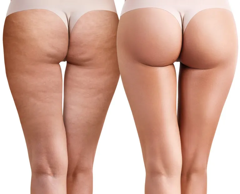 cellulite