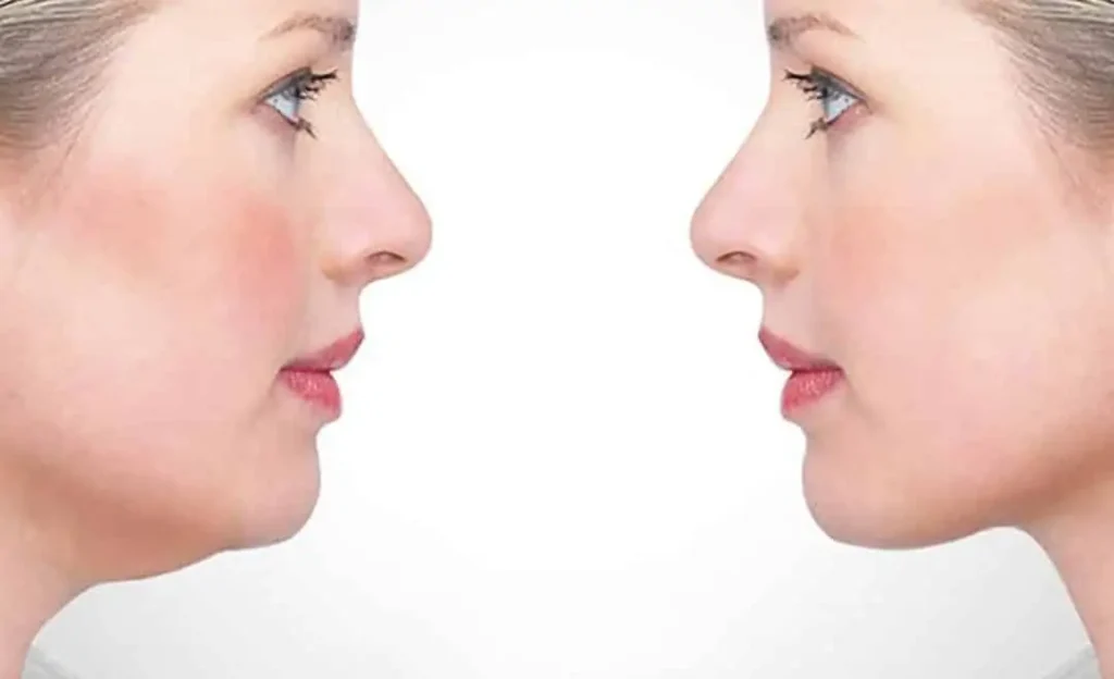double chin mesotherapy