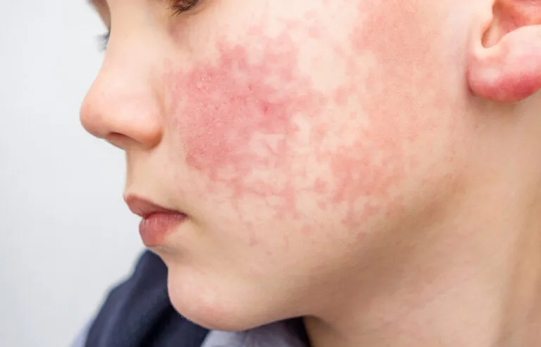 lumecca Treatment (IPL Treatment) 6 lumecca-IPL-treatment-Marina
