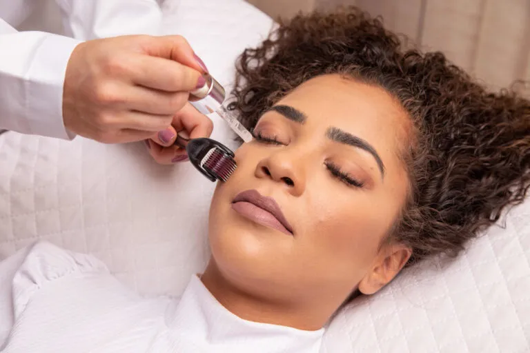 microneedling-RF