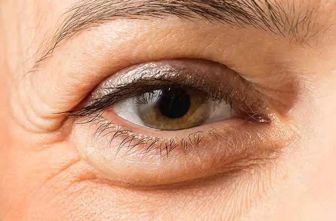 Under eye swelling after morpheus8 1 Under eye swelling after Morpheus8 treatment – understanding post-procedure effects and care tips.