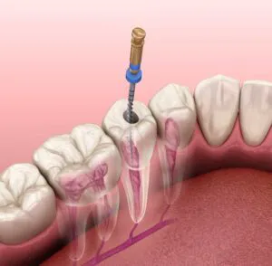 Root Canal Treatment Dubai 2 root-canal-treatment
