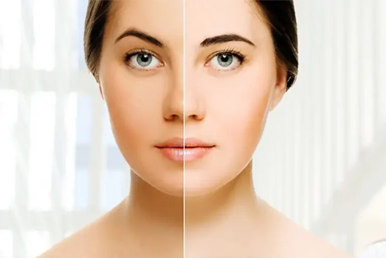 Dubai skin whitening