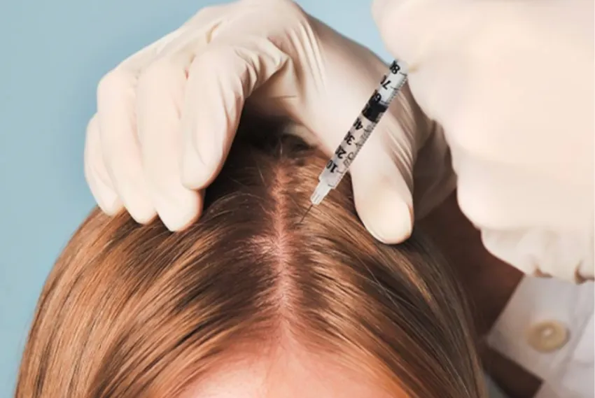 Comparison of mesotherapy and hair filler