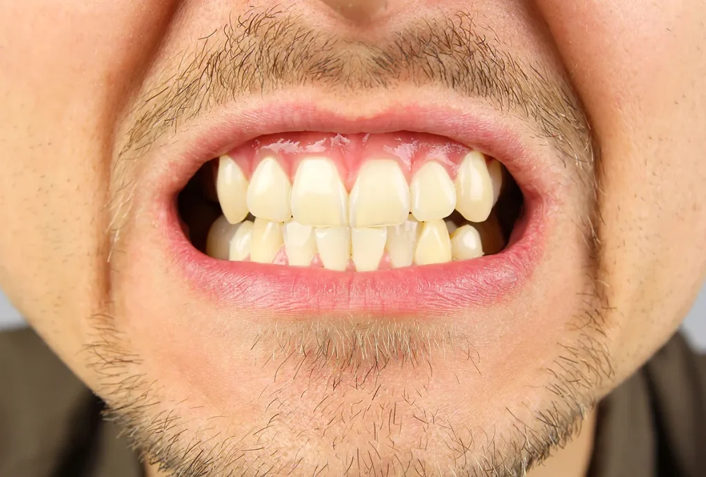 Bad oral and dental habits 3 Grinding teeth