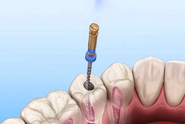 How is dental denervation