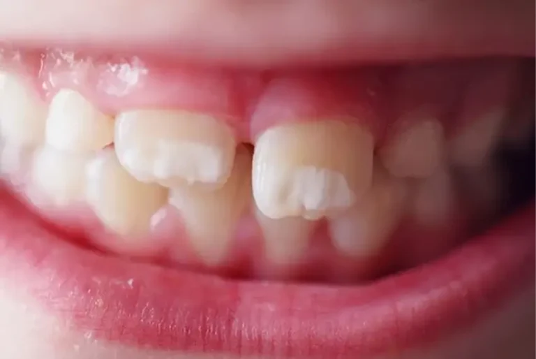 White spots on teeth