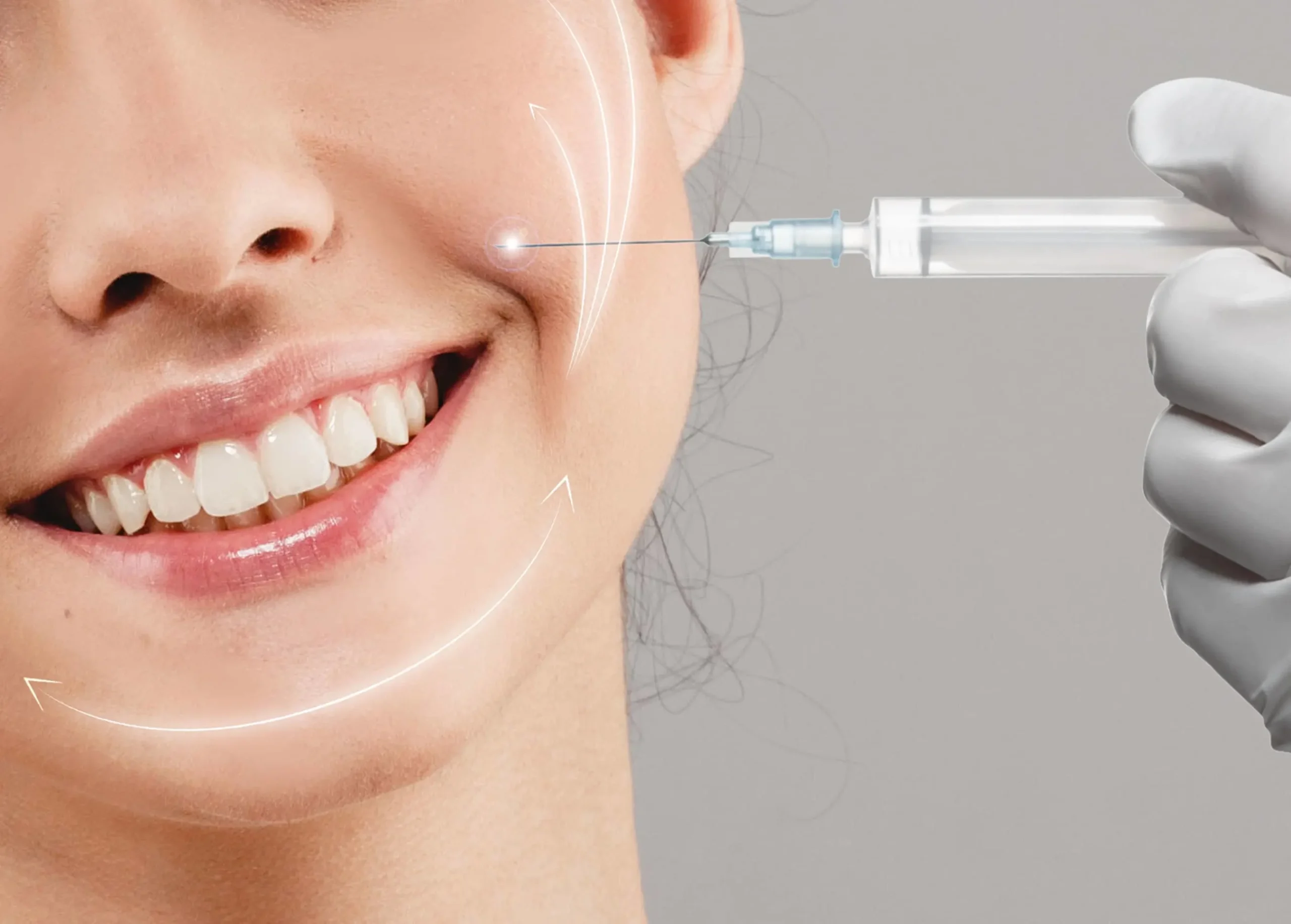 botox for smile line removal