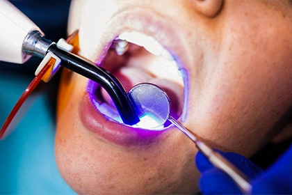 Composite Filling