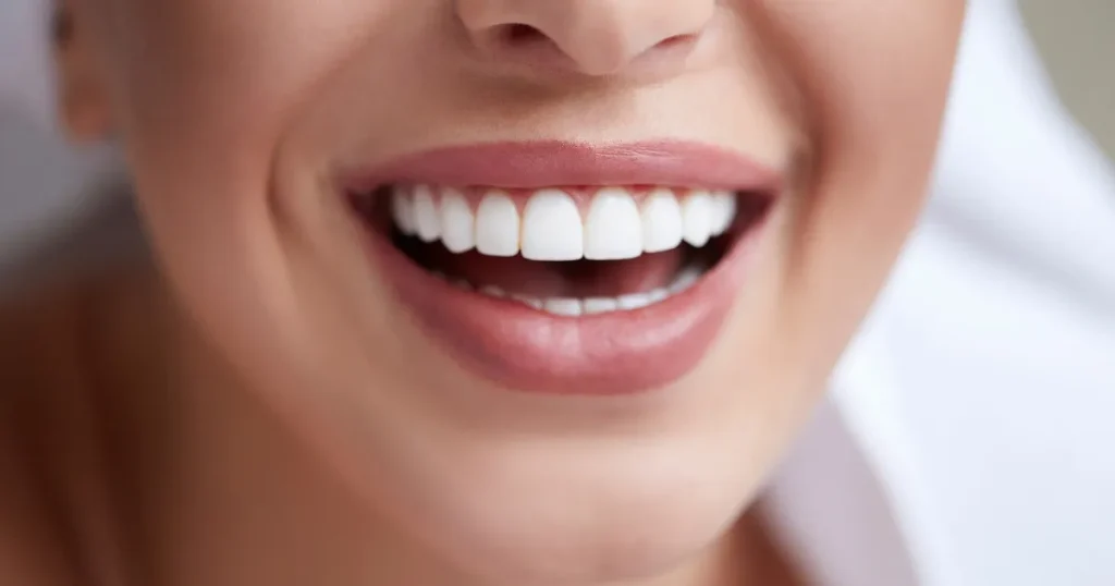 What is Hollywood Smile? 1 What is Hollywood Smile benefits
