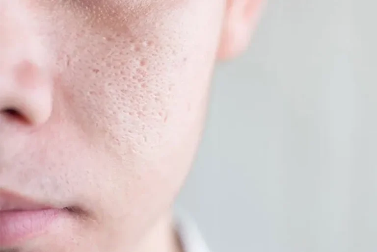 hydrafacial minimize pores