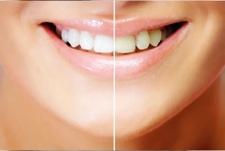 Teeth whitening at home