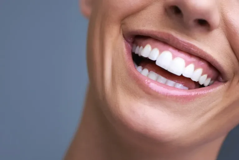 What is Hollywood Smile