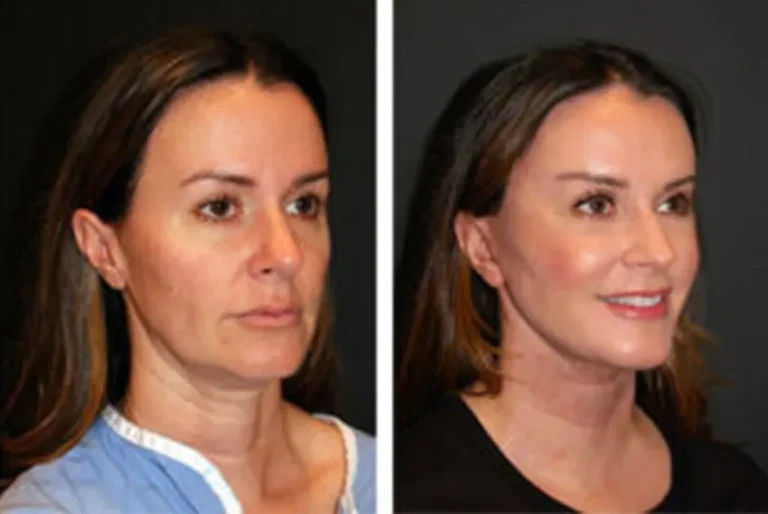 facelift