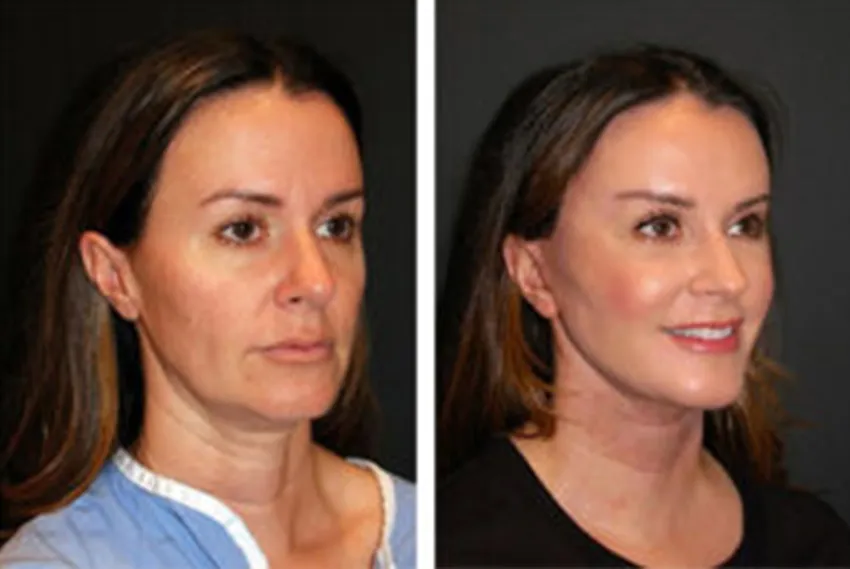 facelift