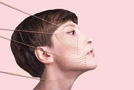 Facial Contouring dubai 2 Facial contouring with thread