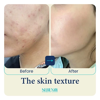Fillers in Dubai 6 The skin texture jawline