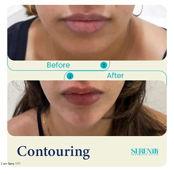 Fillers in Dubai 10 jawline contouring front sahiba