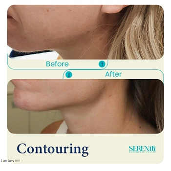 Fillers in Dubai 12 jawline contouring left Adelaida