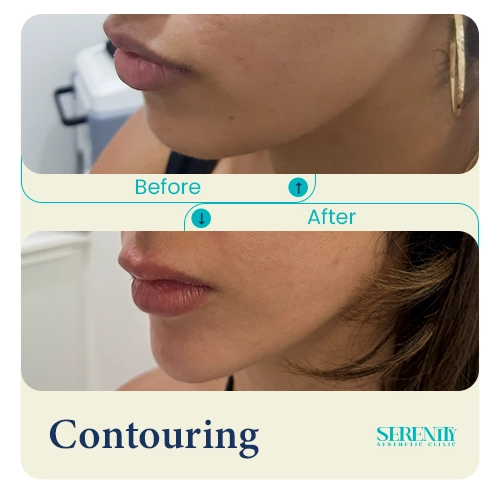 Fillers in Dubai 7 jawline contouring left