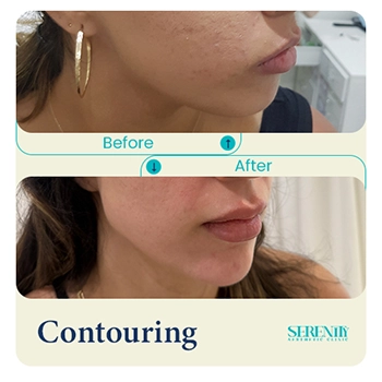 Fillers in Dubai 5 jawline contouring right