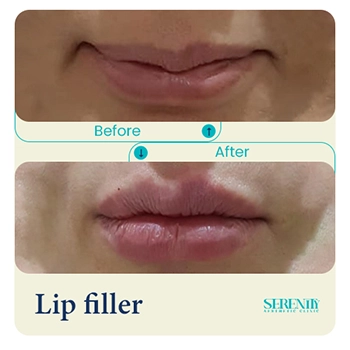 Fillers in Dubai 14 lip filler