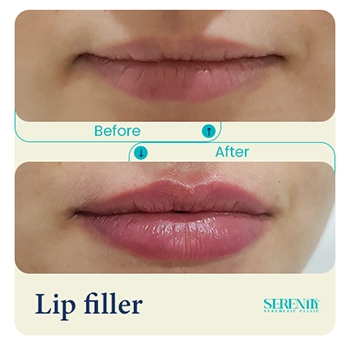 Fillers in Dubai 15 lip filler Katarina
