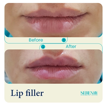 Fillers in Dubai 13 lip filler jana