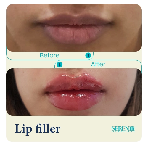 Fillers in Dubai 4 lip filler sahiba