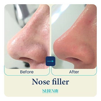 Fillers in Dubai 18 nose filler emma left