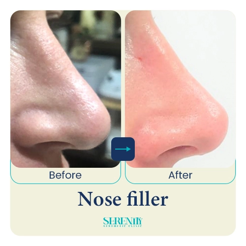 Fillers in Dubai 17 nose filler emma right