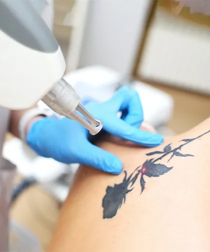 Laser Tattoo Removal Dubai 1 laser tattoo removal