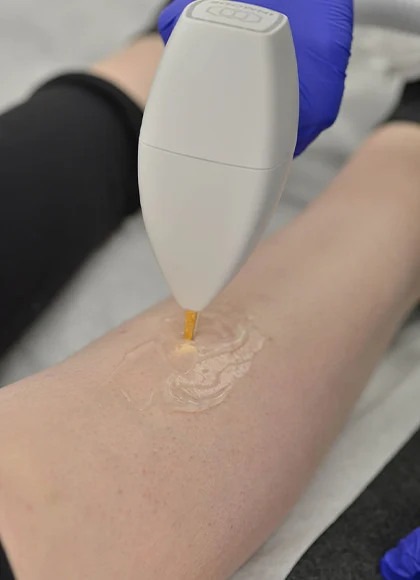 Vasculaze Treatment in Dubai