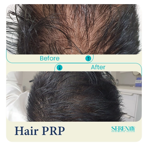 Hair PRP