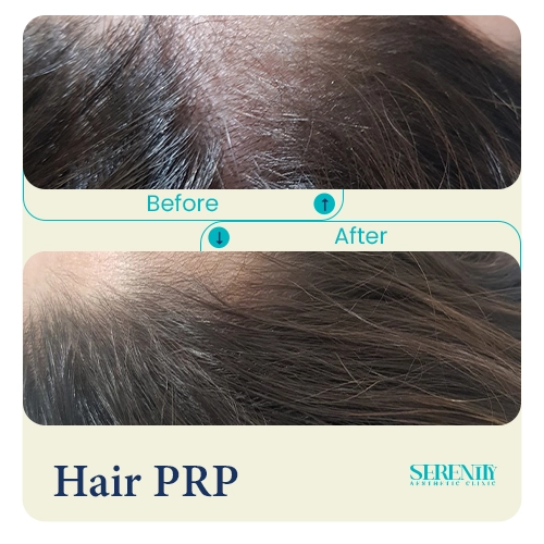 Hair PRP