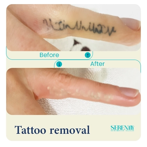 Finger Tattoo removal