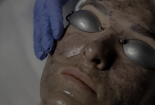 Carbon Peel Laser Facial